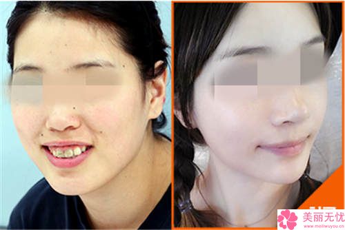 整容要花多少錢就整一張臉？深度解析全臉整形費用構(gòu)成與預(yù)算攻略